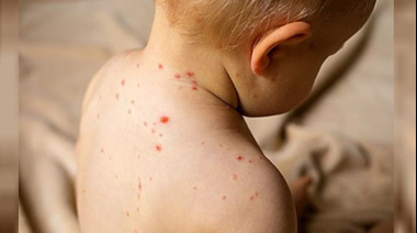 Sarampión: El Ministerio de Salud emitió alerta epidemiológica